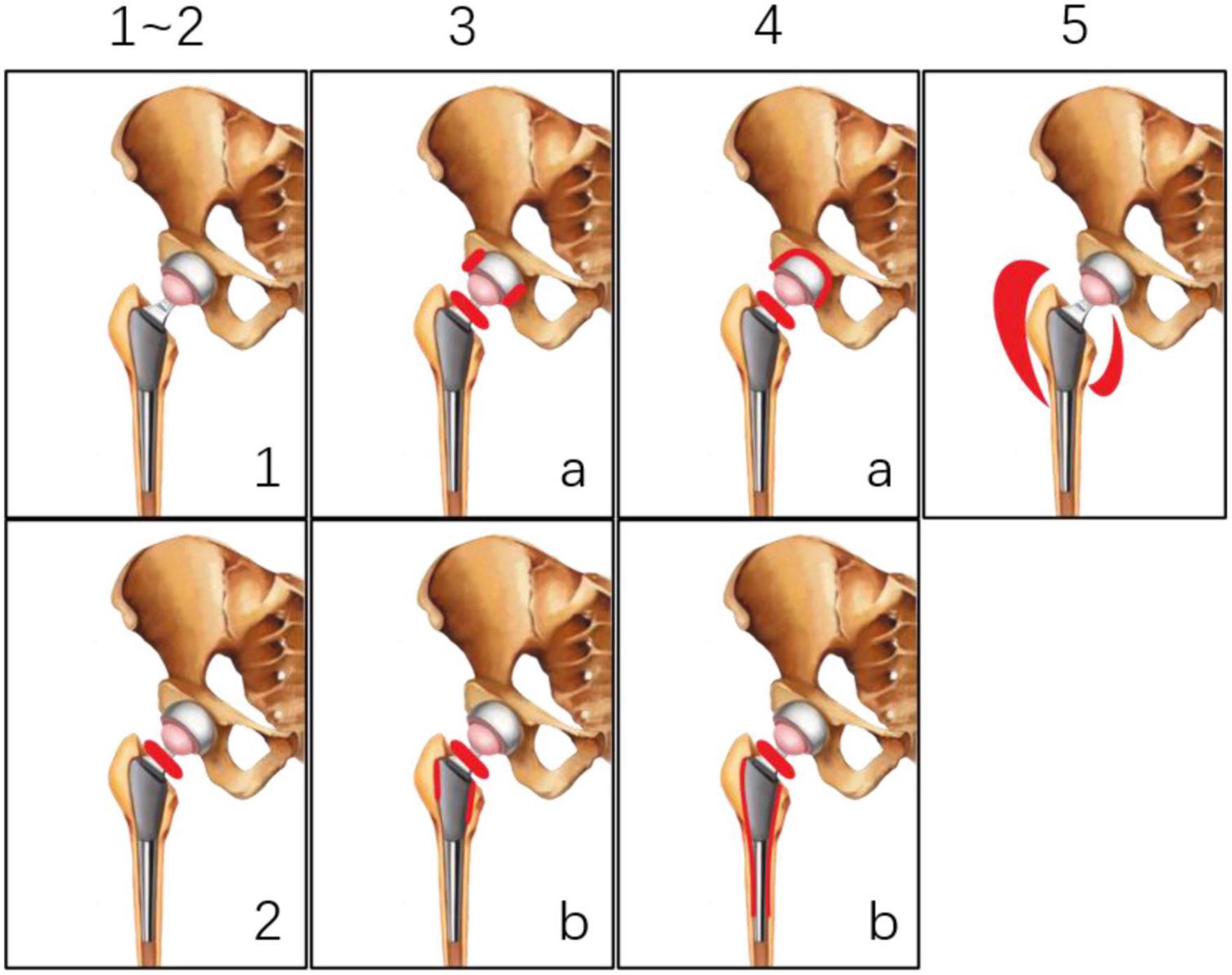 Performance characteristics of 18F–fluorodeoxyglucose in non-infected hip replacement